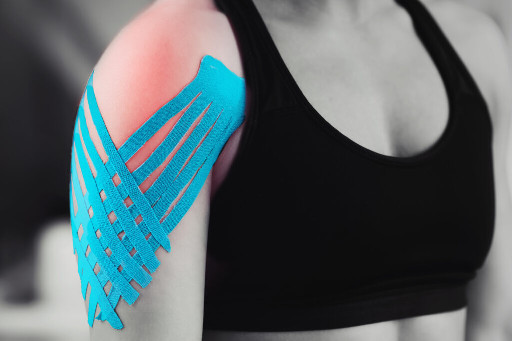 kinesiology taping treatment with blue tape on female patient injured shoulder. Sports injury kinesio treatment.