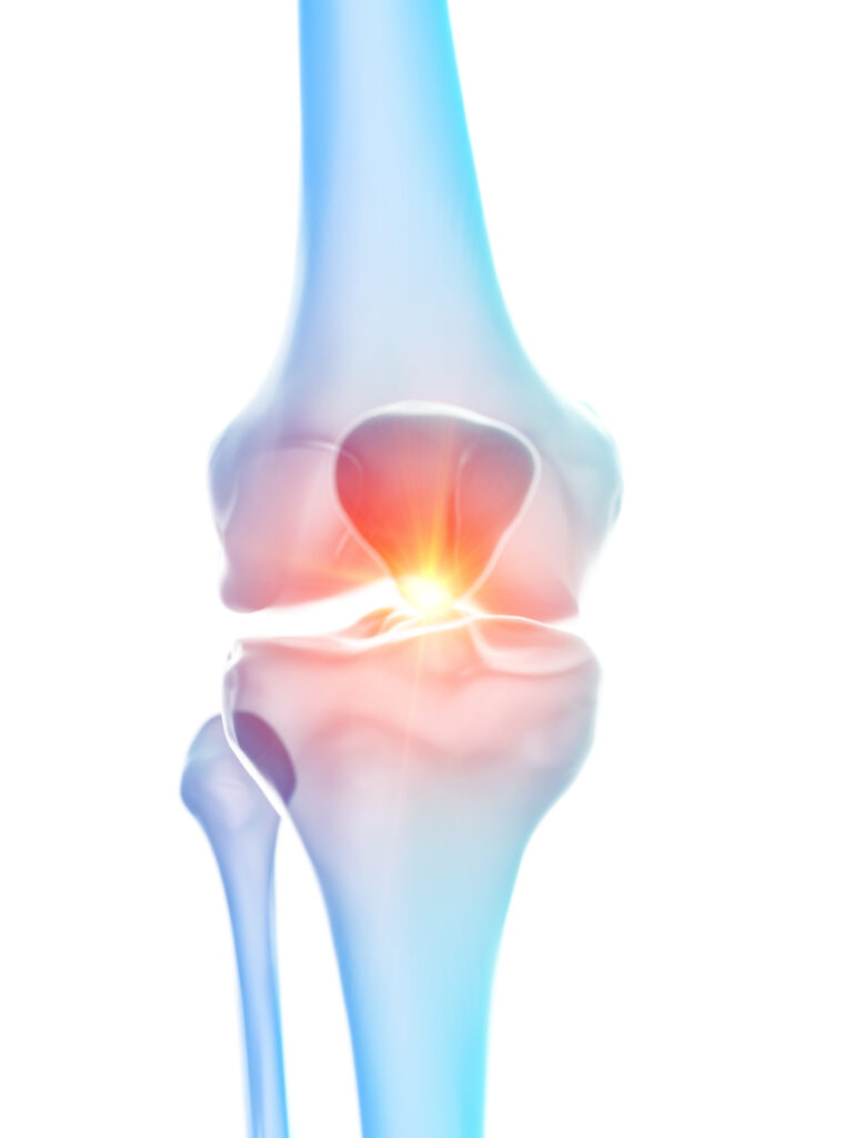 knee joint with inflammation