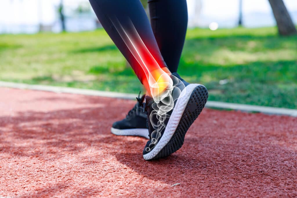 Female athlete walking on track field, low angle view of her shoes and ankle with x-ray image showing sportive injury. Sports injuries concept